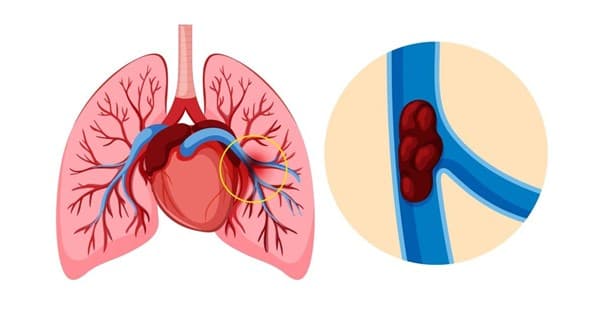 Bol u grudima, simptomi i lečenje